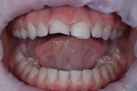 До лечения — Мария З., стоматология «Сальвадор»